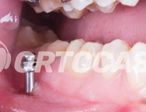 Ortocast #82- Blindando a Estabilidade dos Mini-implantes